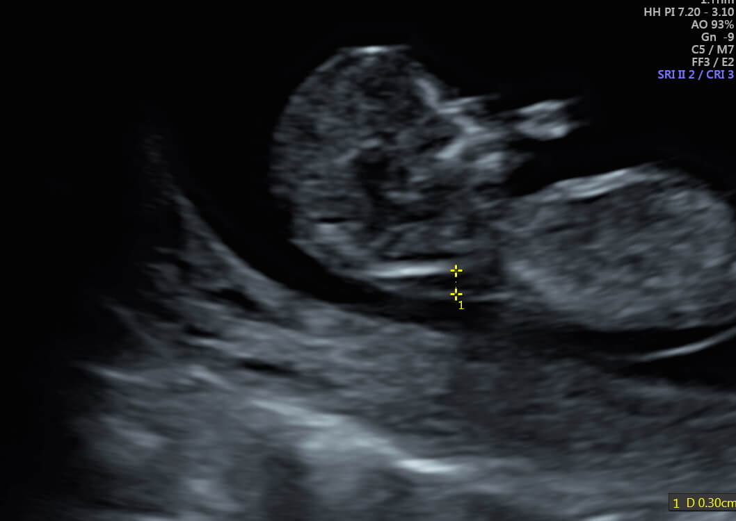 Us obstetric nuchal dating scan in Madrid